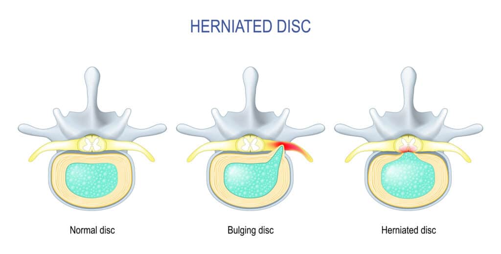 Bulging Disc After a Car Accident: Causes, Recovery & Legal Options ...