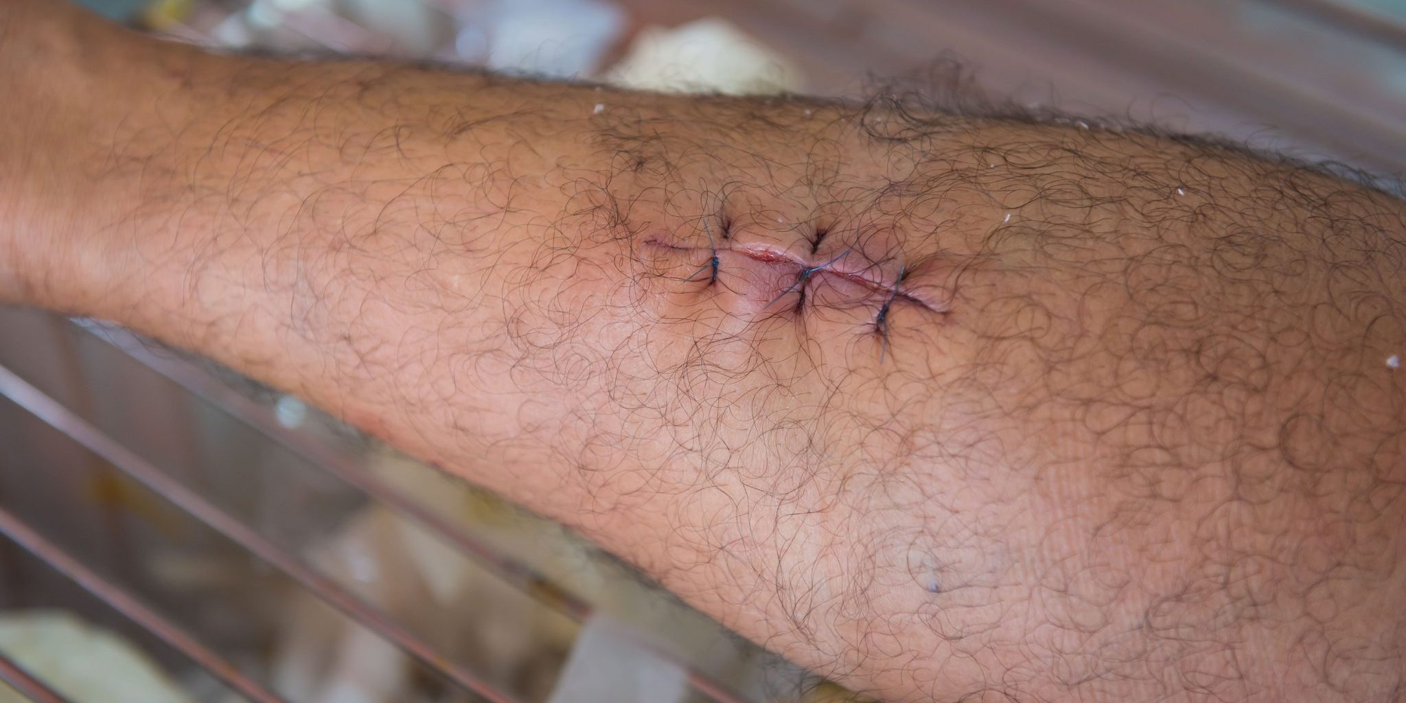 What Does an Infected Dog Bite Look Like A stitched wound on a person's arm, with visible hair, is carefully healing after an infected dog bite.