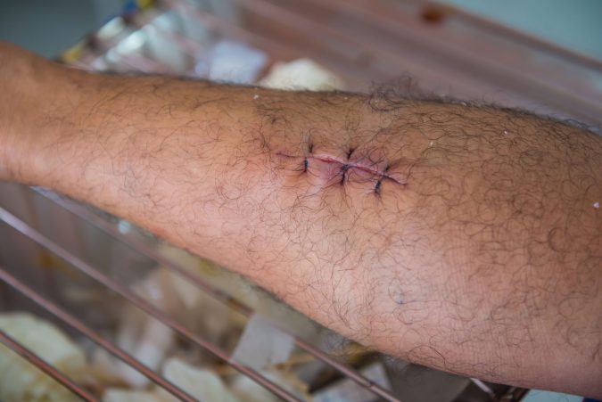 A stitched wound on a person's arm, with visible hair, is carefully healing after an infected dog bite.