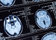 Close-up of multiple brain MRI scan images displayed on a screen, showing cross-sectional views of the human brain with medical data—often used to assess head trauma or spinal cord injuries from motorcycle accidents.