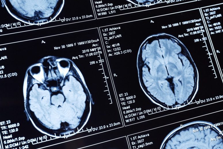 Close-up of multiple brain MRI scan images displayed on a screen, showing cross-sectional views of the human brain with medical data—often used to assess head trauma or spinal cord injuries from motorcycle accidents.